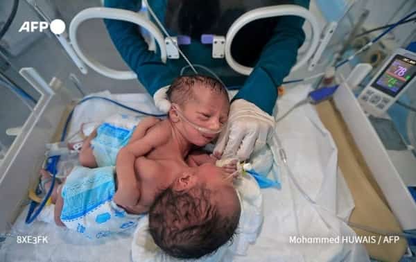 الرياض: مركز الملك سلمان للاغاثة يبدي استجابته "للنداء الإنساني العاجل الذي أطلقه مستشفى السبعين بصنعاء‬⁩ بشأن حالة التوأم السيامي"