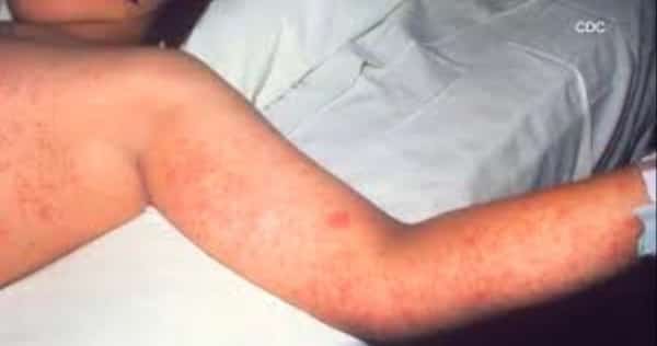 واشنطن: تقرير دولي يقول إن 60% من حالات الإصابة بالحصبة في اليمن تتركز بمناطق سيطرة الحوثيين