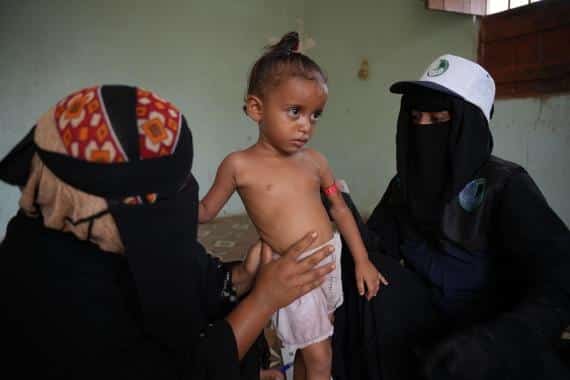 اليمن: 668 طفل يعانون من سوء التغذية في تبن بلحج