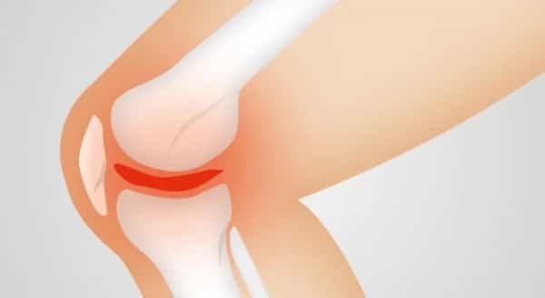 صحة: أعراض ‫التهاب المفاصل الروماتويدي