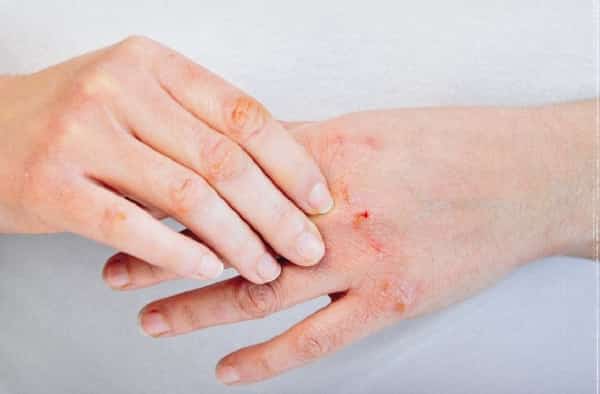 صحة: ما هي الإكزيما التأتبية؟