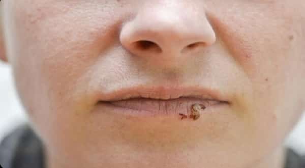 صحة: المخاطر الخفية لفيروس "الهربس"