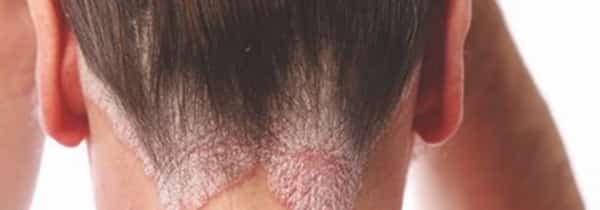 صحة: 9 علاجات منزلية فعّالة للتخلص من صدفية فروة الرأس