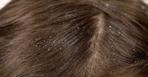 صحة: ما أسباب ظهور قشرة الرأس؟