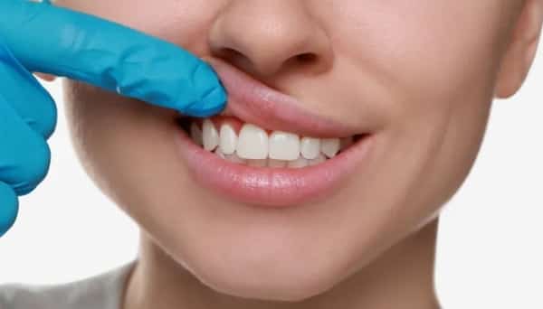 صحة: ‫ما أسباب انحسار اللثة؟