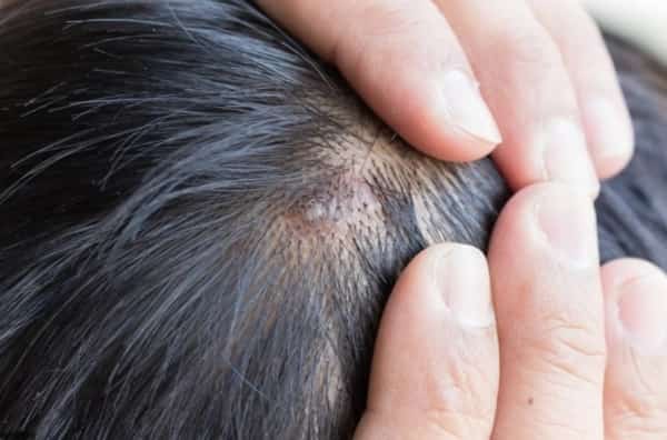 صحة: أسباب ظهور البثور في فروة الرأس