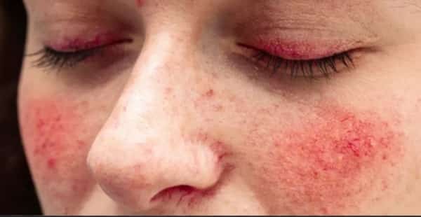 صحة: كيف يمكن التعايش مع الذئبة الحمراء؟