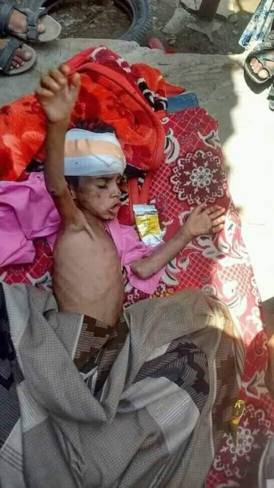 انقاذ طفل وهو يحتضر من عنف عائلته في تعز