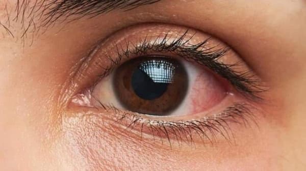 أعراض غير مؤذية لنوع نادر من السرطان