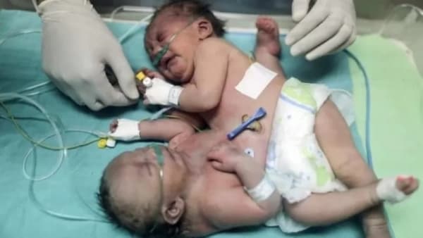 ولادة توأم سيامي ملتصق بمنطقة الصدر والبطن في عمران