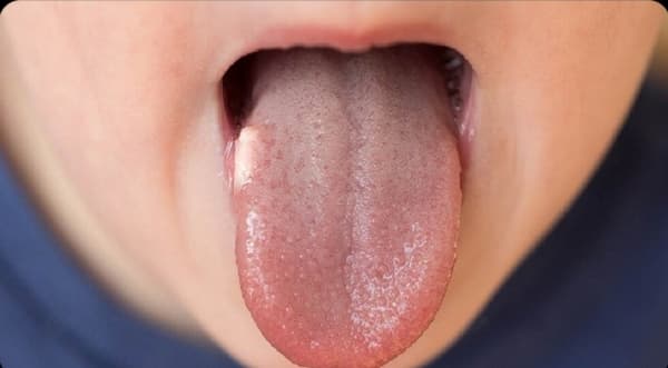 أسباب "سرطان اللسان" وأعراضه