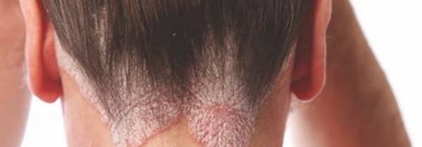 9 علاجات منزلية فعّالة للتخلص من صدفية فروة الرأس