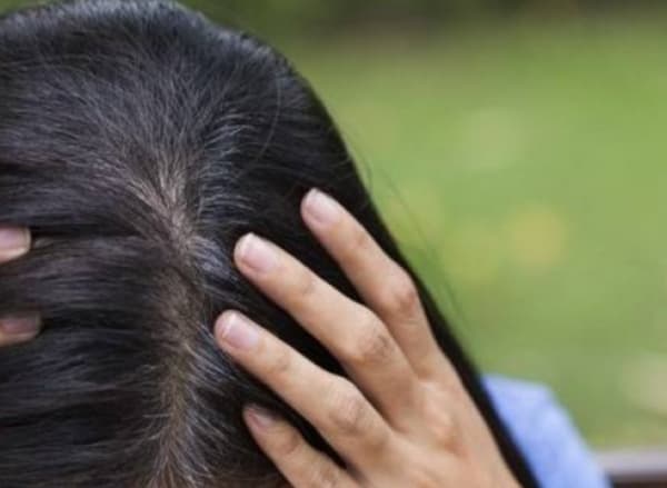 أسباب قشرة الرأس وكيفية التخلّص منها