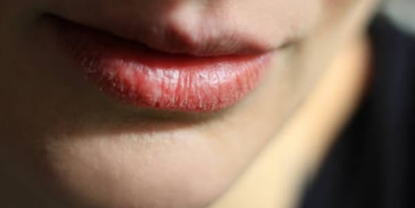 كيف نتجنب تشقق الشفاه في الشتاء؟