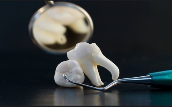 متى يجب قلع أضراس العقل؟