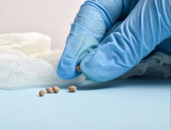 كيف تتشكل حصوات المرارة؟ وهل يمكن تفتيتها بدون جراحة؟