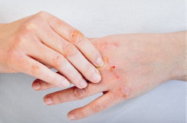 ما هي الإكزيما التأتبية؟