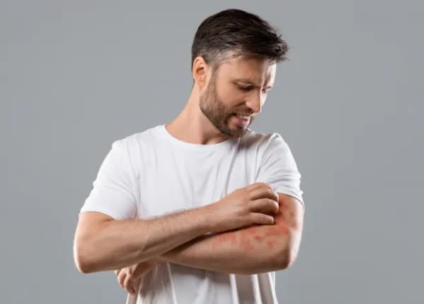 أسباب الحكة العقيدية وأعراضها